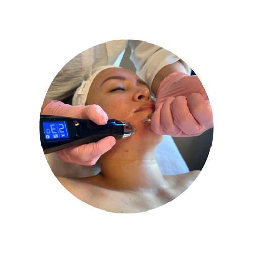 dermapen facial