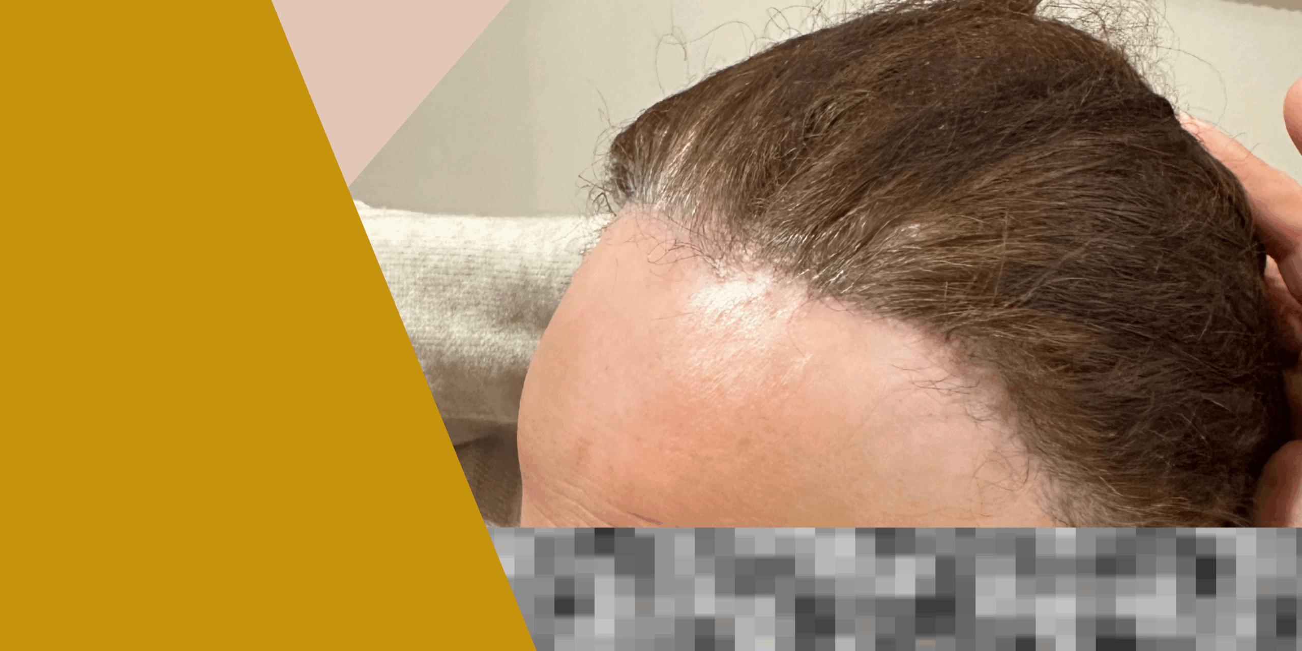 En este momento estás viendo Alopecia frontal fibrosante: ¿qué es y cómo tratarla?