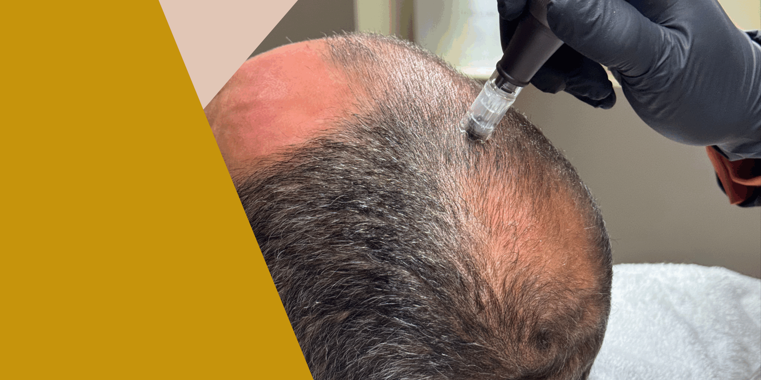 Lee más sobre el artículo Mesoterapia capilar en hombres con Dermapen: frena la caída del cabello
