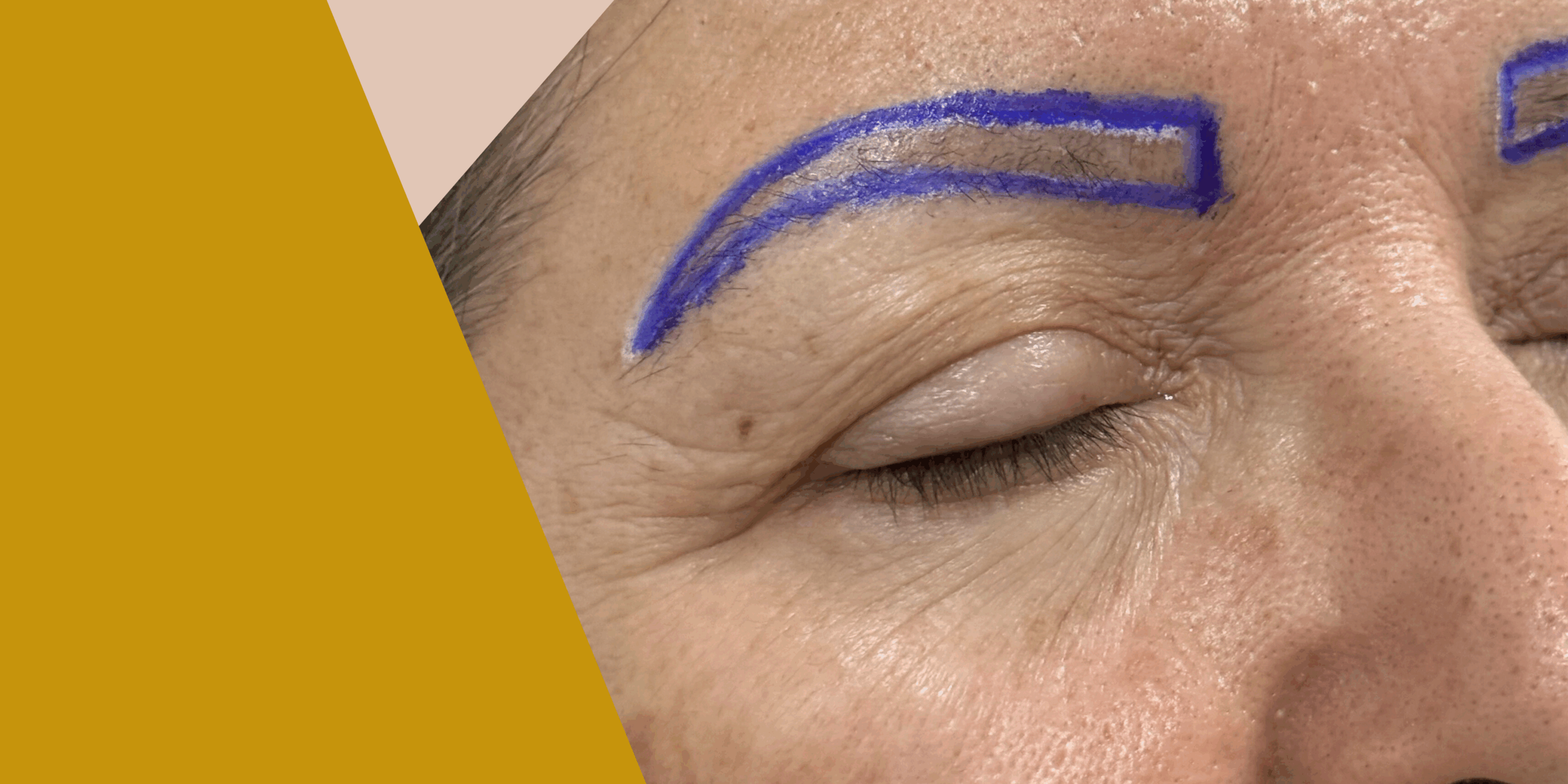 Lee más sobre el artículo Injerto de cejas en Lebrija: una solución estética en auge