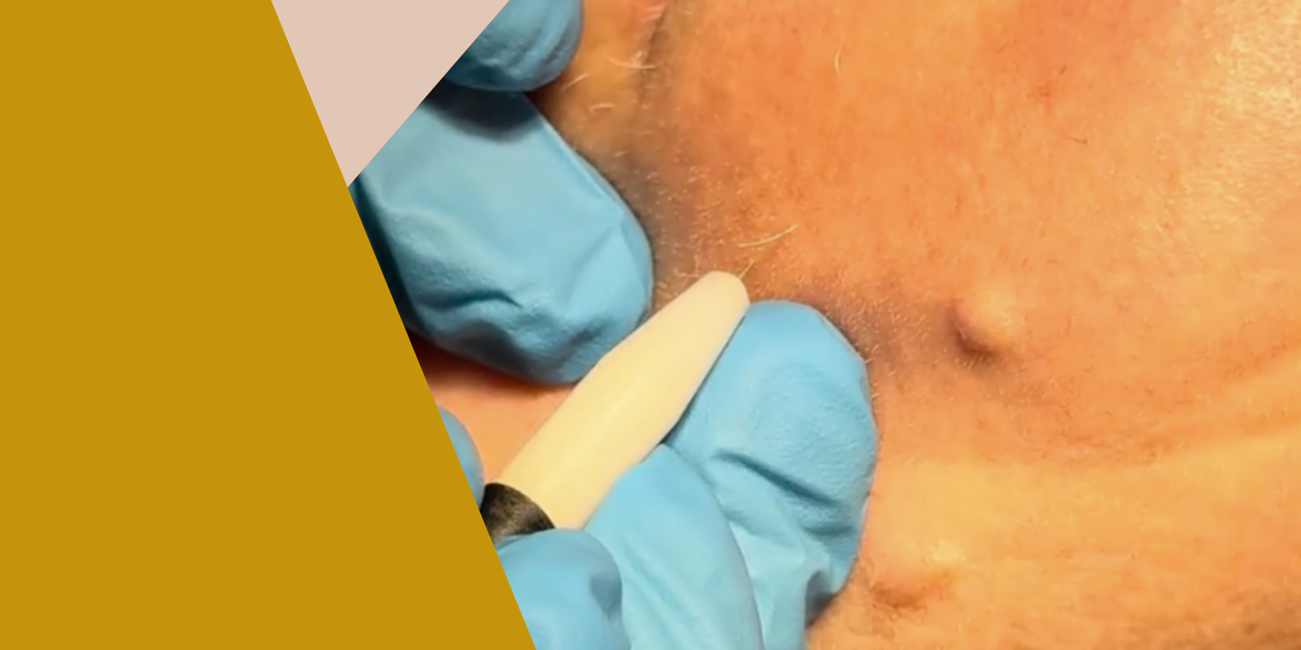 En este momento estás viendo Depilación eléctrica para vello facial blanco: conoce todo